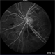 Radiation Retinopathy Radiation Retinopathy
