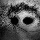 Macular Dystrophy Macular Dystrophy