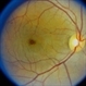 Macular Hole