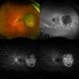 Melanoma Multimodal Evaluation Melanoma Multimodal Evaluation