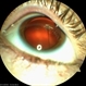 Hyaloid Artery, Anterior Segment Hyaloid Artery, Anterior Segment