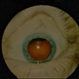 Ciliary Body Choroidal Melanoma Ciliary Body Choroidal Melanoma
