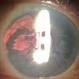 Chronic Uveitis From a Sulcus-Fixated One-Piece Acrylic IOL Chronic Uveitis From a Sulcus-Fixated One-Piece Acrylic IOL