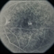 Macular Hole Evolving / Lamellar Hole Macular Hole Evolving / Lamellar Hole