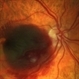 RAMA, Valsalva Retinopathy RAMA, Valsalva Retinopathy