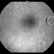 Late fluorescein Angiography of Right Optic Pit Late fluorescein Angiography of Right Optic Pit