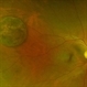 Solitary large Congenital Hypertrophy  of Retinal Pigment Epithelium (CHRPE) Solitary large Congenital Hypertrophy  of Retinal Pigment Epithelium (CHRPE)