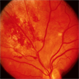 CMV Retinitis in AIDS Patient CMV Retinitis in AIDS Patient