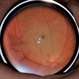 Cilioretinal artery occlusion Cilioretinal artery occlusion