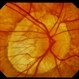 Peripapillary Atrophy With High Myopia Peripapillary Atrophy With High Myopia