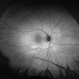 Branch Retinal Artery Occlusion Branch Retinal Artery Occlusion
