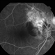 Polypoidal Choroidal Vasculopathy