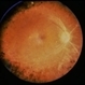 Necrotizing Retinitis Necrotizing Retinitis