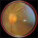 Bergmeisters-Papilla : Smartphone Fundus Image Bergmeisters-Papilla : Smartphone Fundus Image