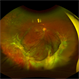Proliferative vitreoretinopathy in complex retinal redetachment Proliferative vitreoretinopathy in complex retinal redetachment