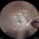 Venous Stasis Retinopathy