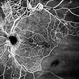 Central Retinal Vein Occlusion by OCT Angiography Central Retinal Vein Occlusion by OCT Angiography