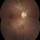 Gardner's Syndrome (FAP) Gardner's Syndrome (FAP)