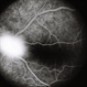 Retinal Capillary Hemangioblastoma Retinal Capillary Hemangioblastoma