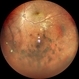 Intermediate uveitis