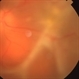 Acute Retinal Necrosis with Proliferative Vitreoretinopathy and Total Retinal Detachment Acute Retinal Necrosis with Proliferative Vitreoretinopathy and Total Retinal Detachment