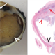 Chronic Vogt-Koyanagu-Harada (VKH) Disease Chronic Vogt-Koyanagu-Harada (VKH) Disease