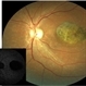 Stargardt's Disease Stargardt's Disease