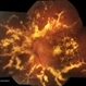 Diabetic Retinopathy, CSME, Exudates, NVD, Color Fundus Photo, Montage