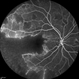 Idiopathic Occlusive Retinal Vasculitis (Late Stage) Idiopathic Occlusive Retinal Vasculitis (Late Stage)