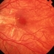 High Myopia with Lacquer Cracks High Myopia with Lacquer Cracks