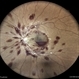 Anaemic Retinopathy Anaemic Retinopathy