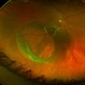 Complex Retinal Detachment with PVR and Starfold Complex Retinal Detachment with PVR and Starfold