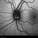 Blue autofluroscence of  Left eye optic nerve head showing auto fluorescence of the drusen Blue autofluroscence of  Left eye optic nerve head showing auto fluorescence of the drusen