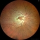 BRAO (Branch Retinal Artery Occlusion) BRAO (Branch Retinal Artery Occlusion)