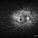 Pigmentary Retinal Dystrophy Pigmentary Retinal Dystrophy