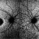 Macular dystrophy Macular dystrophy