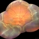 Choroidal Detachment Choroidal Detachment