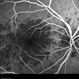 Persistent Placoid Maculopathy Persistent Placoid Maculopathy