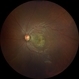 Optic disc pit Optic disc pit