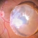 Dropped Nucleus in Vitreous Dropped Nucleus in Vitreous