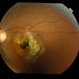 Macular Coloboma