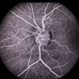 Preretinal Vascular Loop