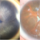 Iris Bombé in Late-Stage Pediatric Retinal Detachments