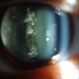 Vitreous Amyloidosis Slit Lamp Photo