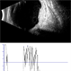 Choroidal Hemangioma, Ecography Choroidal Hemangioma, Ecography