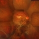 Post Traumatic ERM With Large Retinal Tear Post Traumatic ERM With Large Retinal Tear