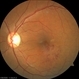 Macular-BRVO Macular-BRVO