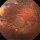 Treated Retinal Tear