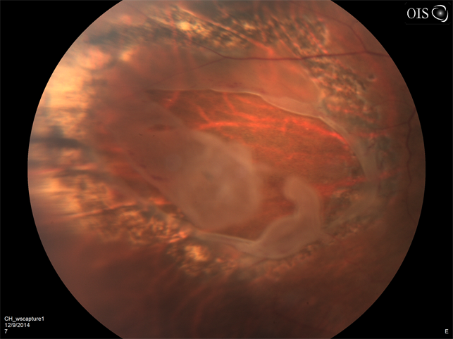 Treated Retinal Tear - Retina Image Bank