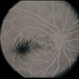 Scleritis / OIS Scleritis / OIS